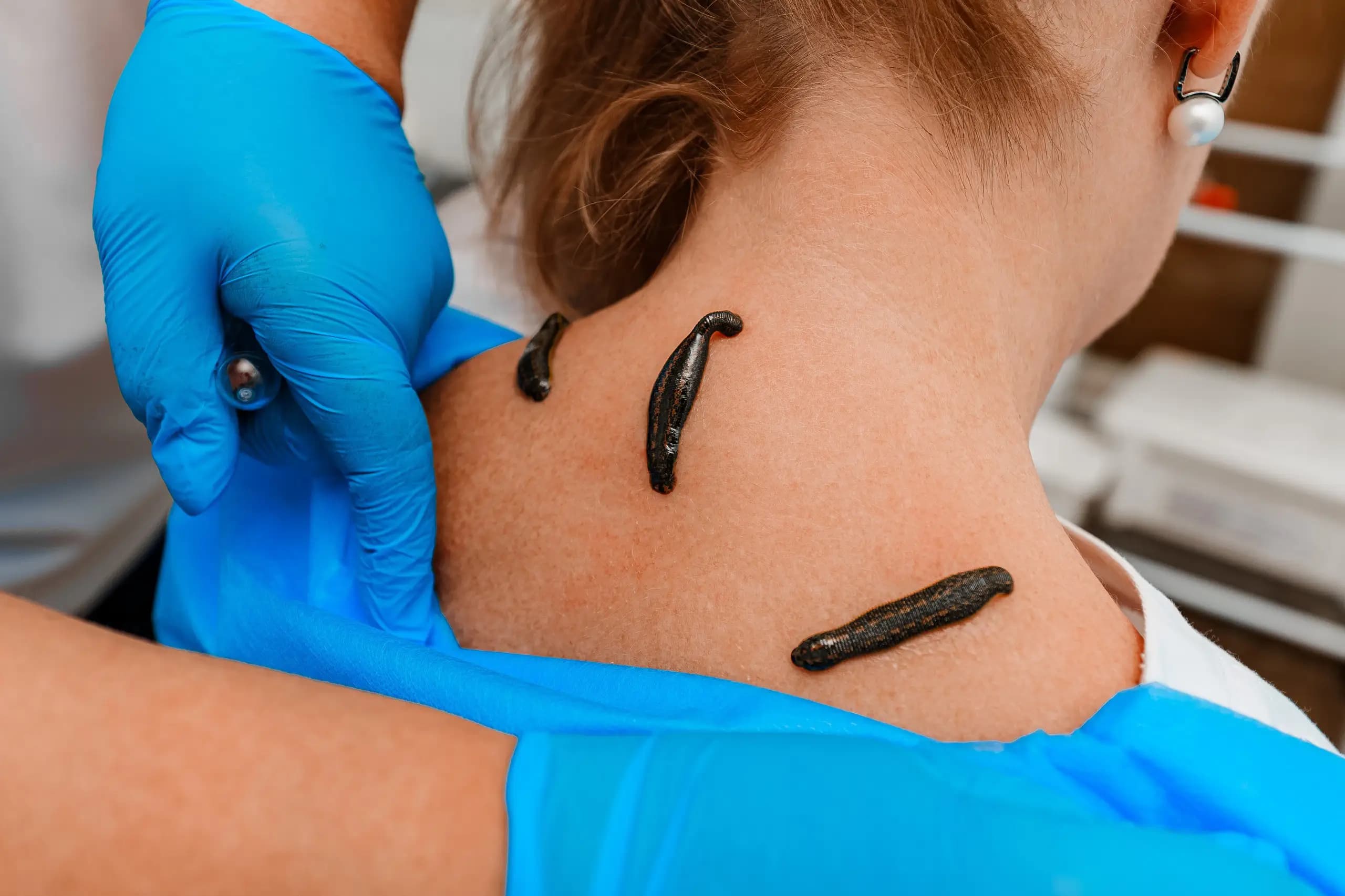 Гирудотерапия